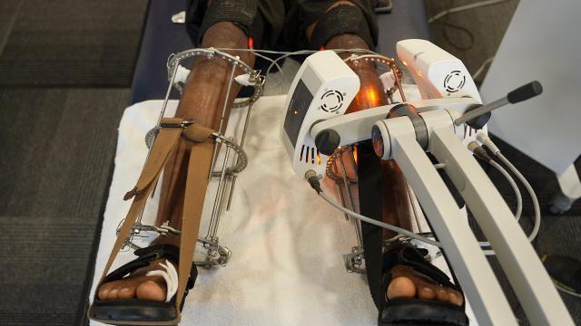 Expert team preparing for limb lengthening consultation session