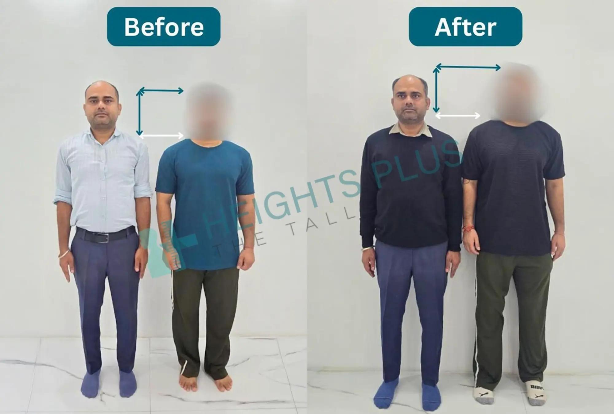 Before and after limb lengthening surgery consultation with specialist