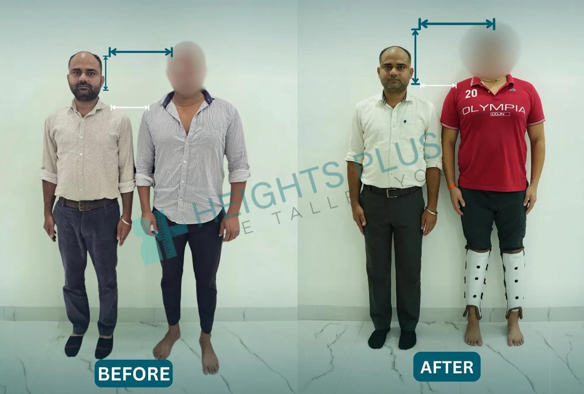 Senior Physiotherapy Consultant for height increase surgery rehab