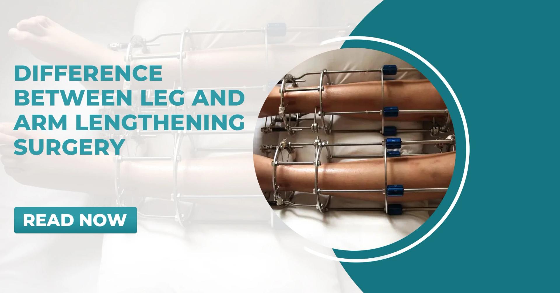 Difference Between Leg and Arm Lengthening Surgery