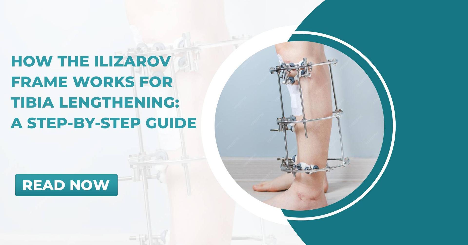 Ilizarov Frame Works for Tibia Lengthening